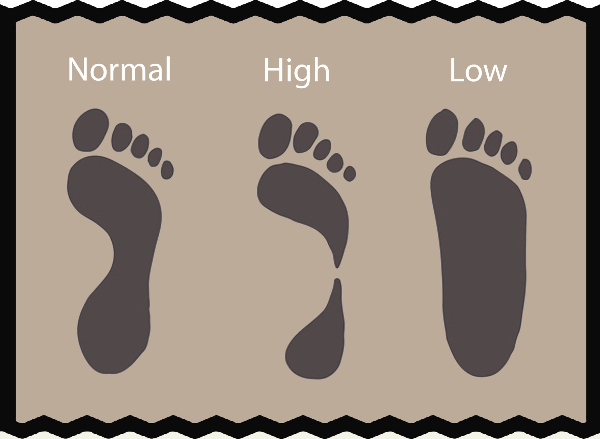 Signs You Need Arch Support